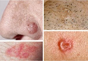 What is a BCC (Basal Cell Carcinoma)?
